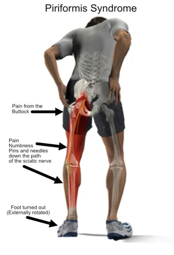 Is walking good for piriformis syndrome?