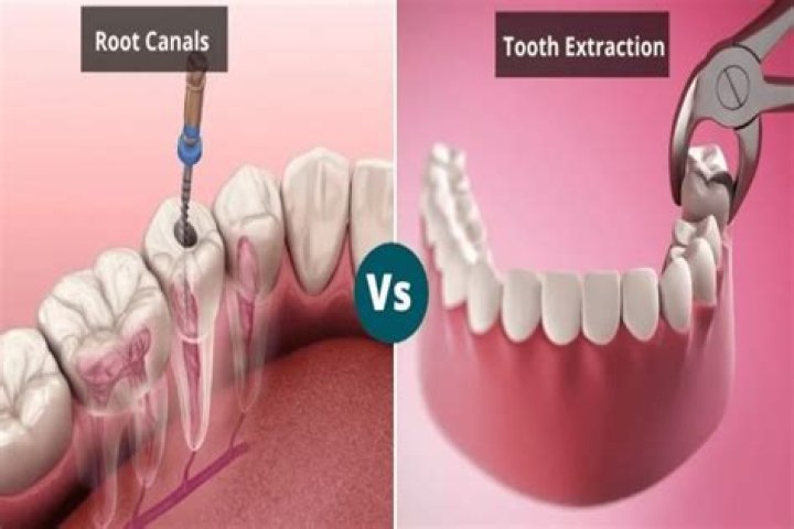 Should I get a second root canal or extraction?