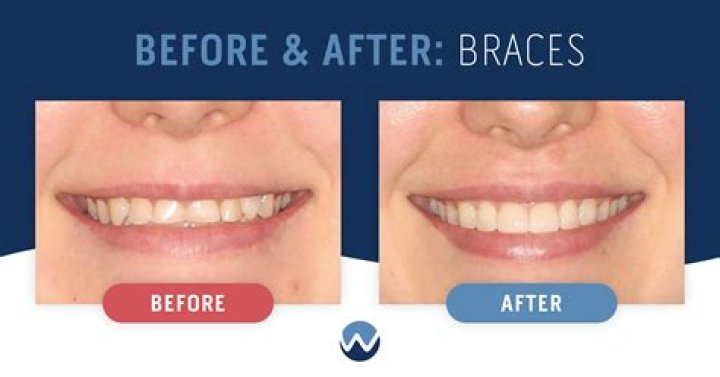 Should I get braces at 28?