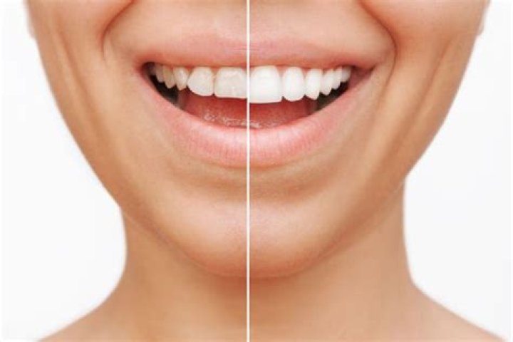 Should I whiten my teeth before getting a crown?