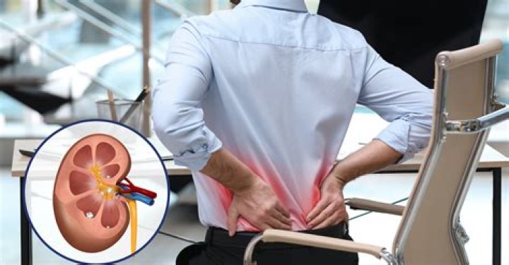 What are the first signs of passing a kidney stone?