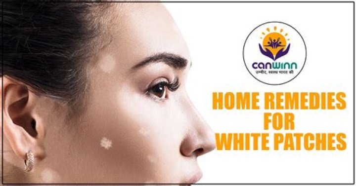 What are the home remedies for white patches on face?
