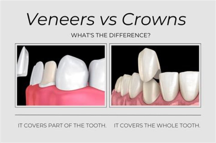 What are the problems with veneers?