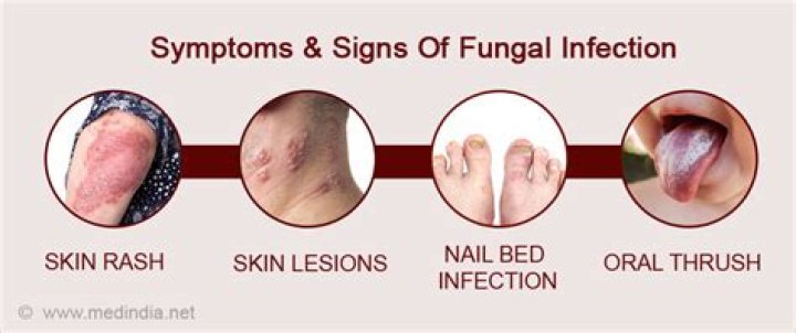 What are the symptoms of fungus in the body?