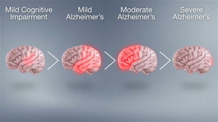 What bacteria causes Alzheimer's?