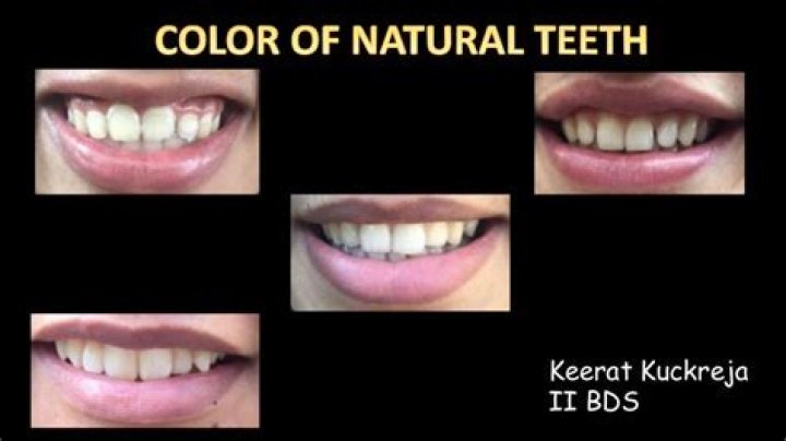 What color should teeth naturally be?
