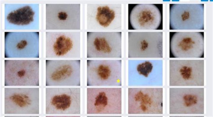 What do cancerous freckles look like?