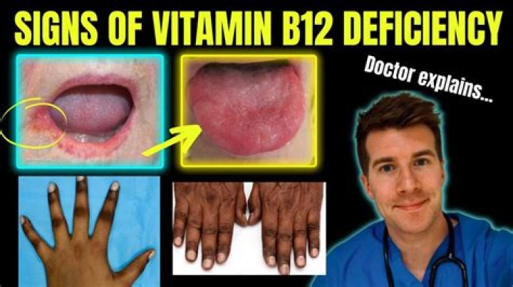 What does a B12 deficiency tongue look like?