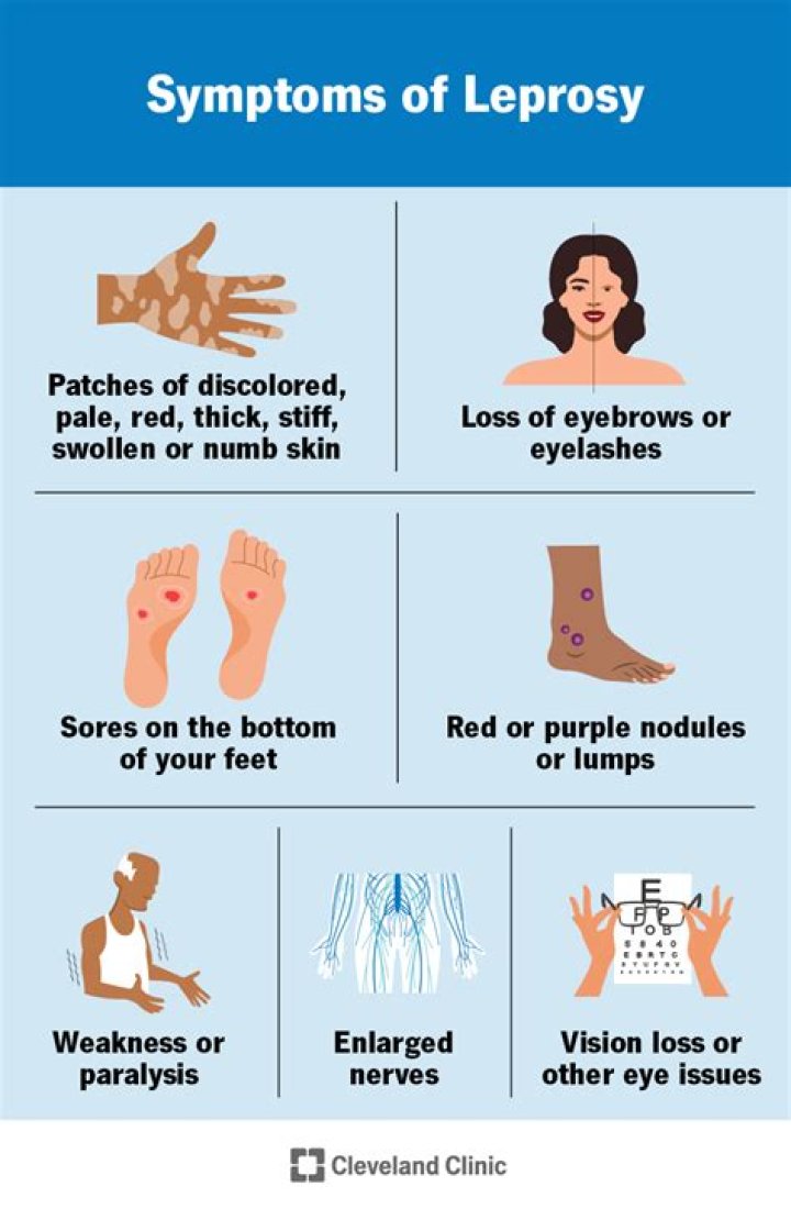 What does a person with leprosy look like?