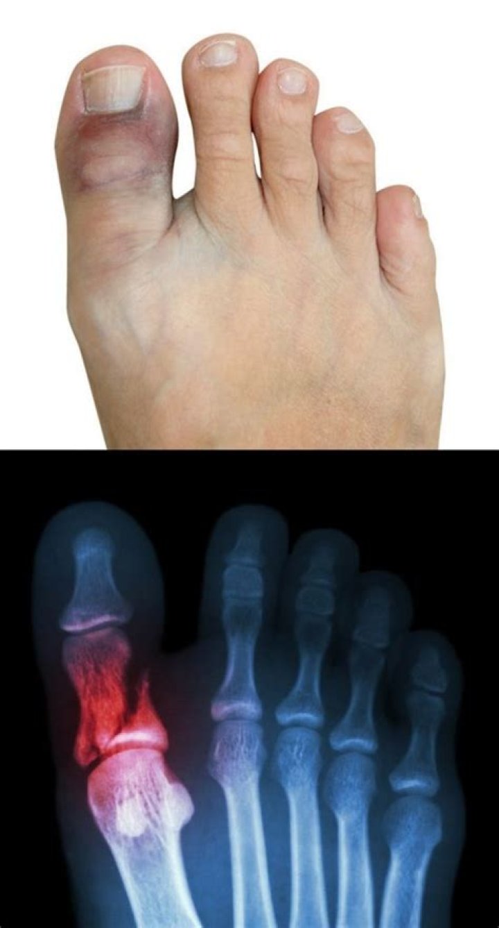 What does a sprained toe look like?