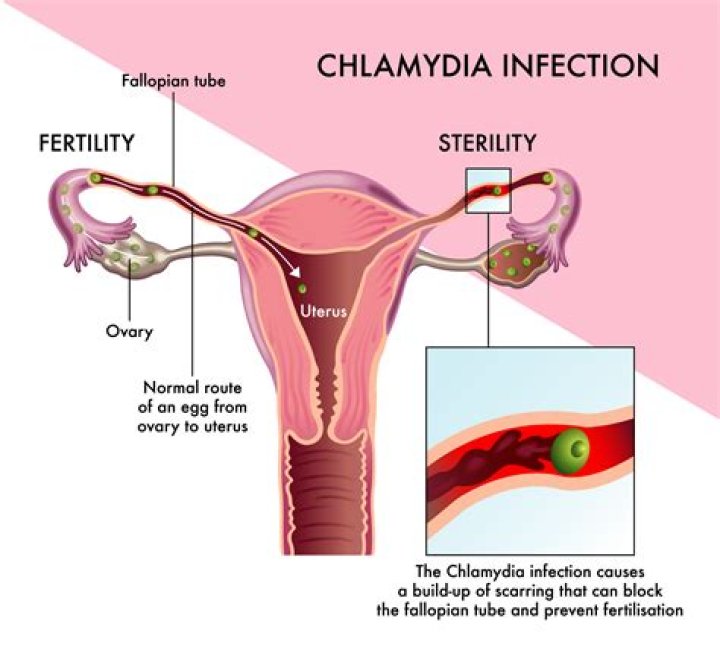 What does chlamydia pain feel like?