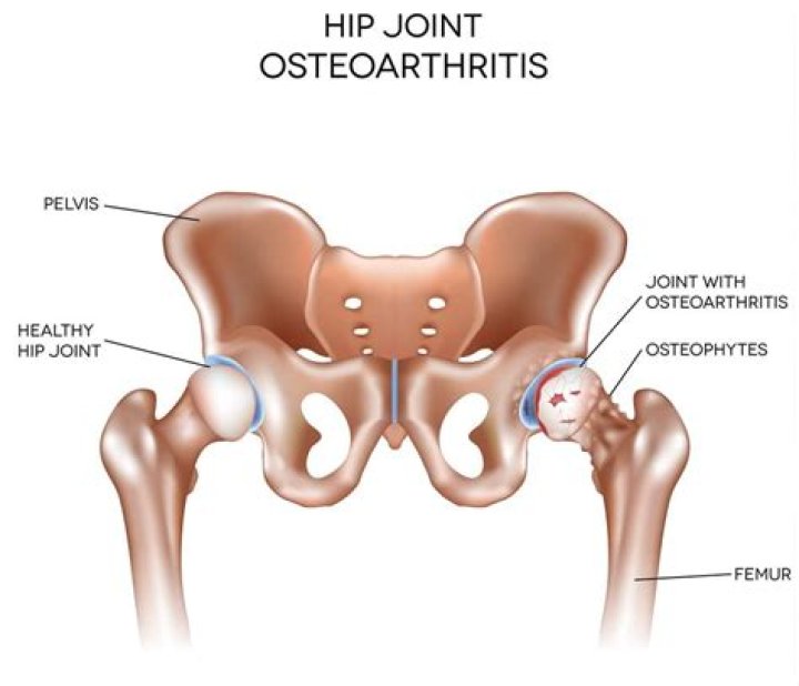 What does hip arthritis feel like?