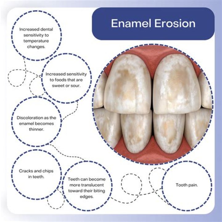 What does weak tooth enamel look like?