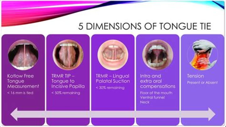 What happens after tongue-tie release in adults?