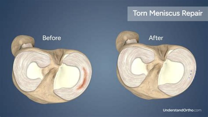 What happens if you don't repair a torn meniscus?