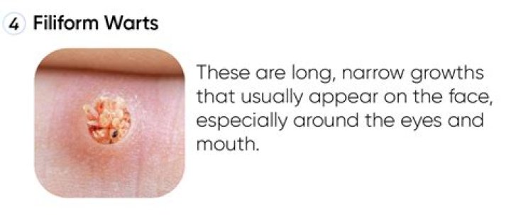 What happens if you pick a wart?