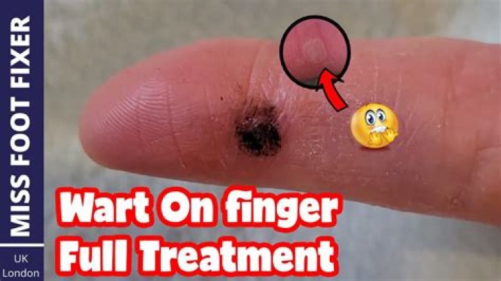 What happens if you pull out a wart?