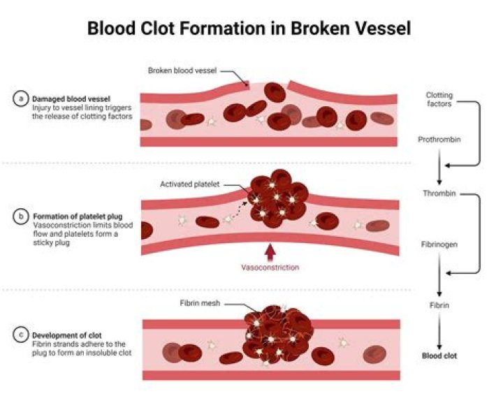 What happens when a blood clot moves?