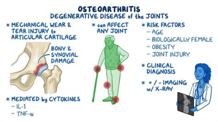 What is considered severe osteoarthritis?