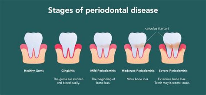 What is the first stage of periodontal disease?