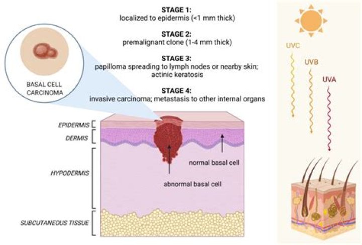 What is the most aggressive subtype of basal cell carcinoma?