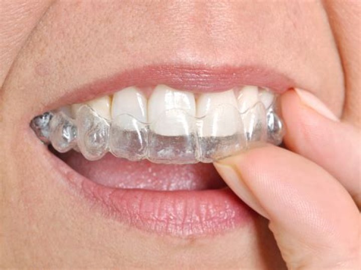 What is the shortest time for Invisalign?