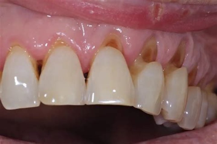 What is trench mouth?