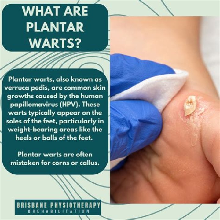 What kills the wart virus?