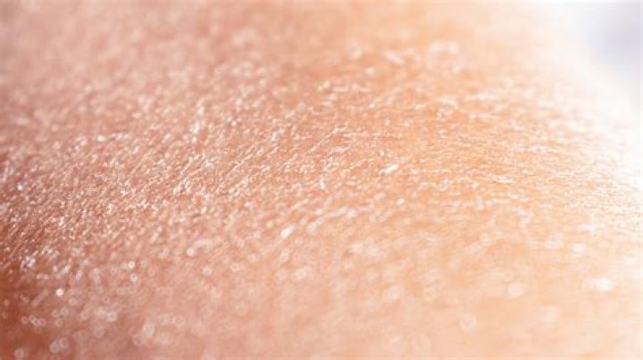 What to put on peeling nipples?