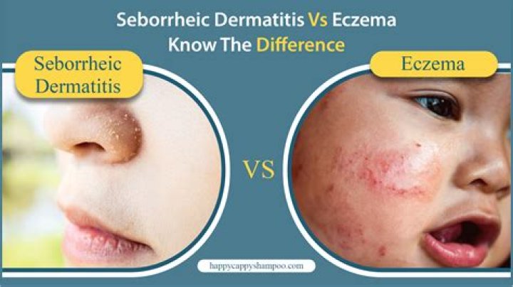 Whats the difference between dermatitis and eczema?