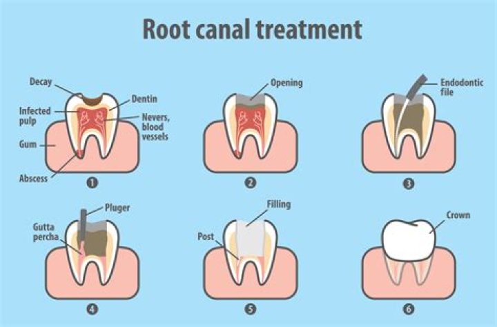 When is it too late for a root canal?