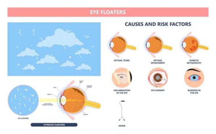 When should I worry about eye floaters?