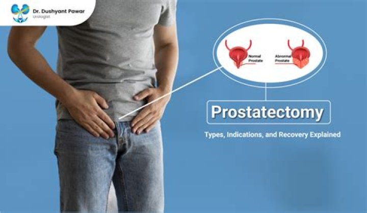 When should you have your prostate removed?
