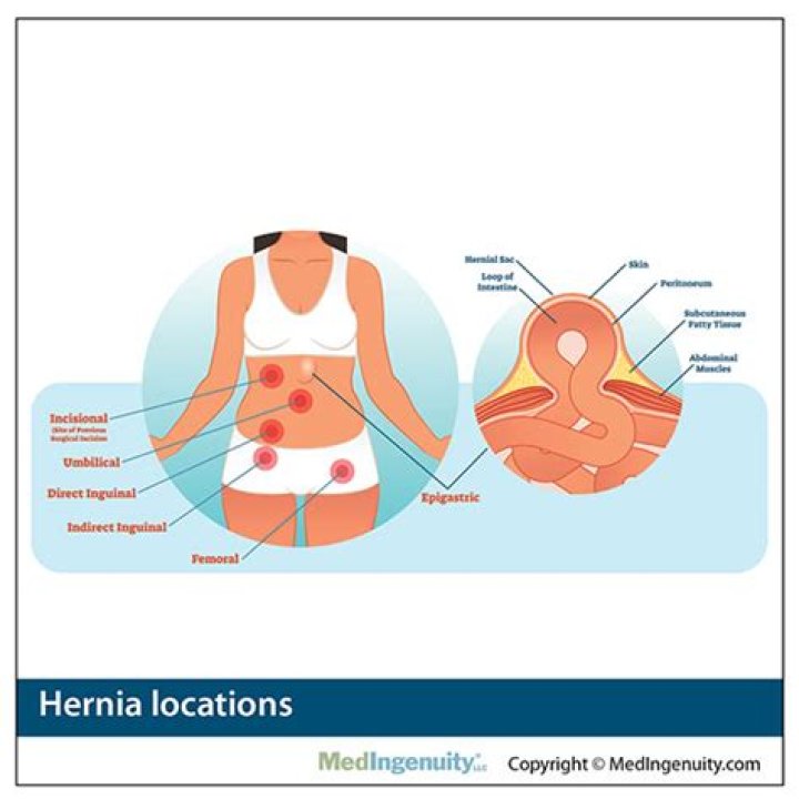 Where are women's hernias located?
