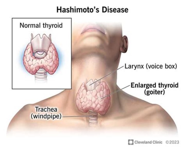 Where does your neck hurt with thyroiditis?