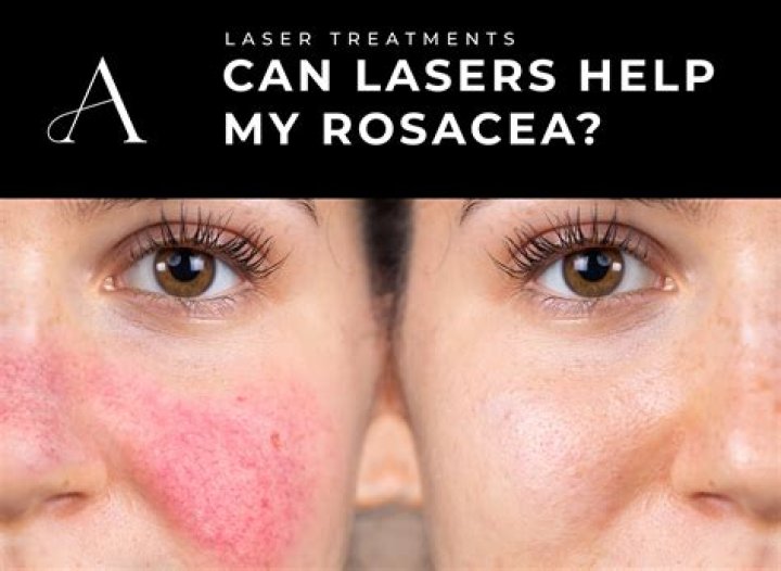 Which laser is best for dark spots?