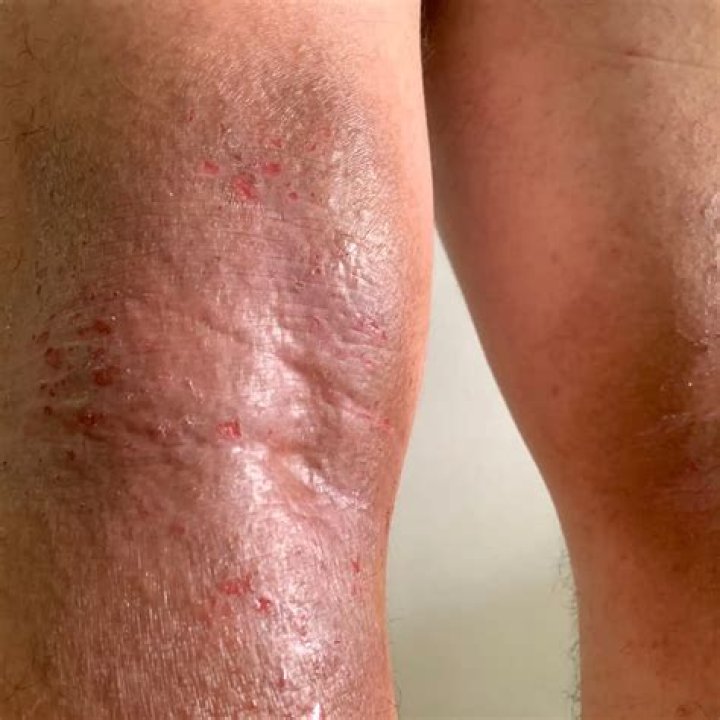 Why does my eczema flare-up after a shower?