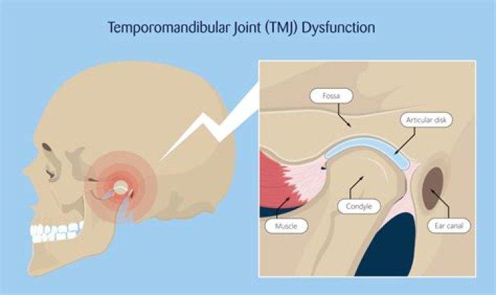 Why is my TMJ getting worse?