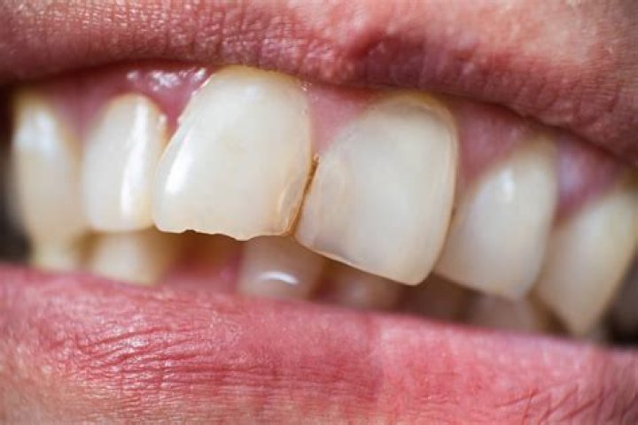 Will a chipped tooth get worse?