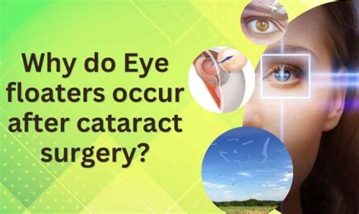 Will cataract surgery eliminate floaters?
